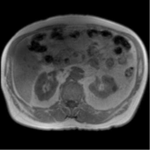 Annular pancreas (Radiopaedia 38292-40320 Axial T1 IN-OPP 42).png