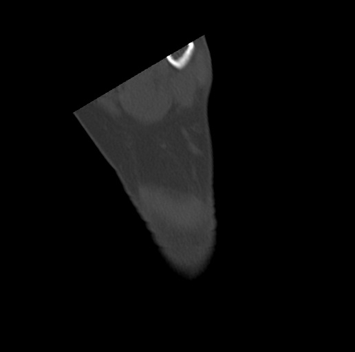 File:Anterior calcaneal process fracture (Radiopaedia 47384-51989 Coronal bone window 75).png