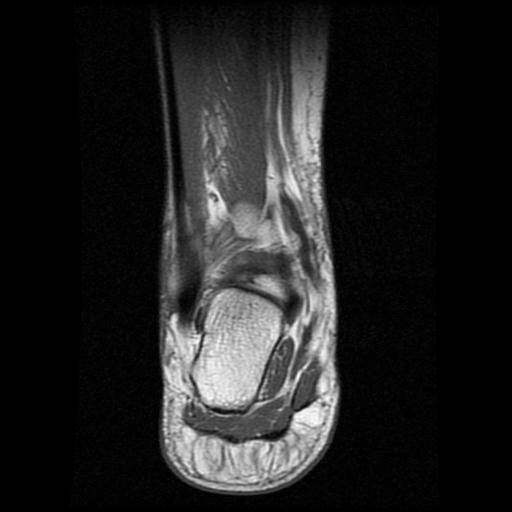 File:Anterior calcaneal process fracture (Radiopaedia 71377-81705 Coronal T1 12).jpg