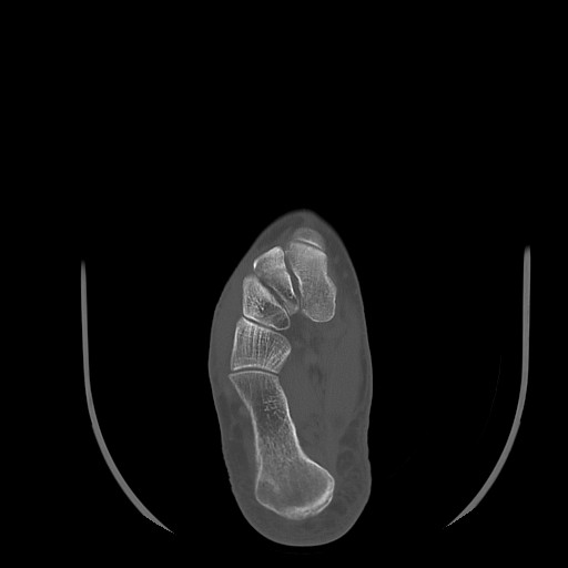 Anterior calcaneal process fracture (Radiopaedia 82590-96762 Axial bone window 27).jpg