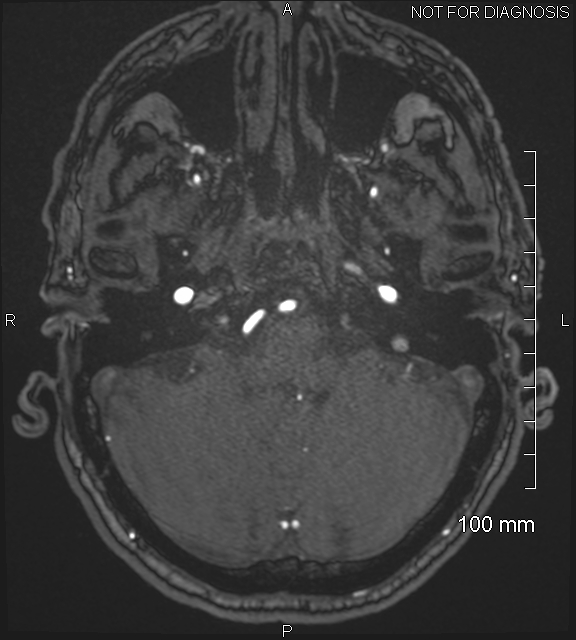 Anterior cerebral artery aneurysm (Radiopaedia 80683-94127 Axial MRA 44).jpg