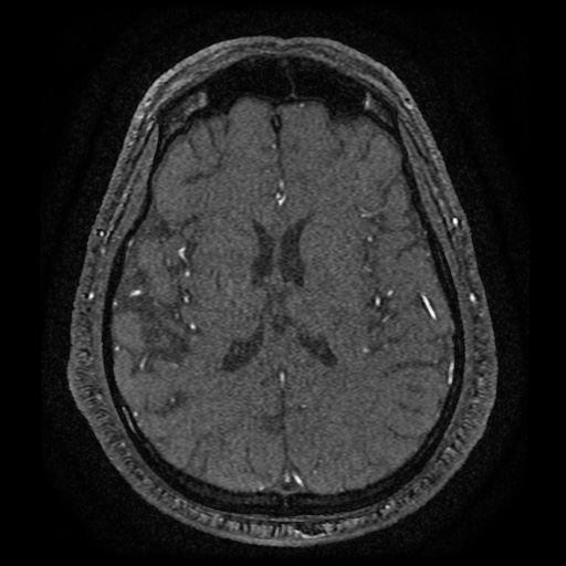 Anterior cerebral artery infarction (Radiopaedia 46794-51323 Axial MRA 128).jpg