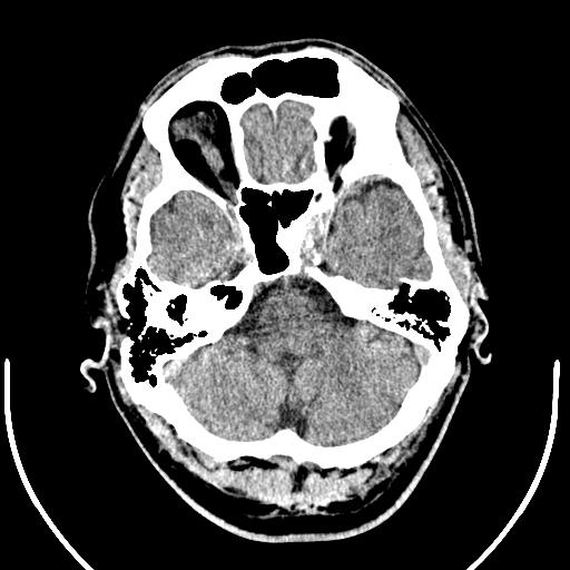 Anterior choroidal artery infarct (Radiopaedia 55106-61480 Axial non-contrast 10).jpg