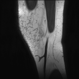 Anterior cruciate ligament rupture with Segond fracture (Radiopaedia 69043-78806 Sagittal PD 13).jpg