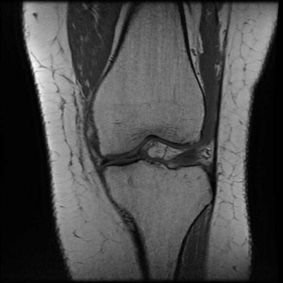 File:Anterior cruciate ligament tear, Wrisberg rip and bucket-handle tear of medial meniscus (Radiopaedia 75872-87266 Coronal T1 12).jpg
