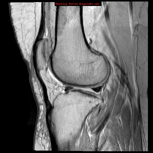 File:Anterior cruciate ligament tear (Radiopaedia 12329-12612 Sagittal T2 fat sat 7).jpg