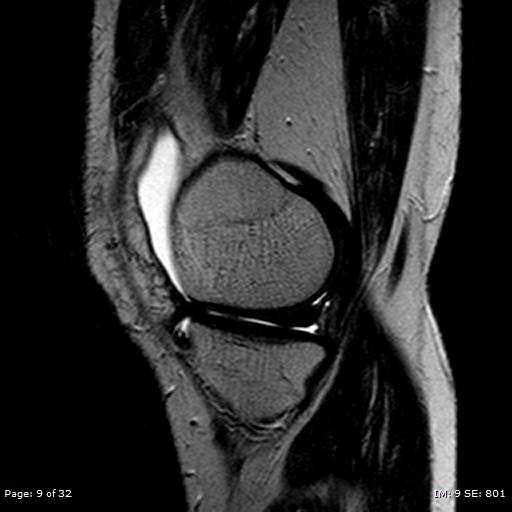 File:Anterior cruciate ligament tear (Radiopaedia 70783-80964 Sagittal T2 9).jpg