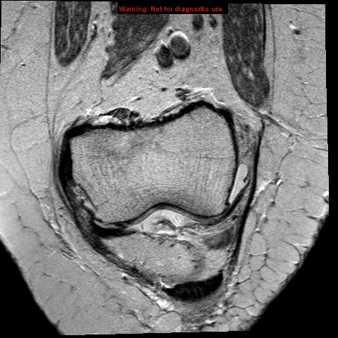 File:Anterior cruciate ligament tear - complete (Radiopaedia 12175-12514 Coronal PD 3).jpg