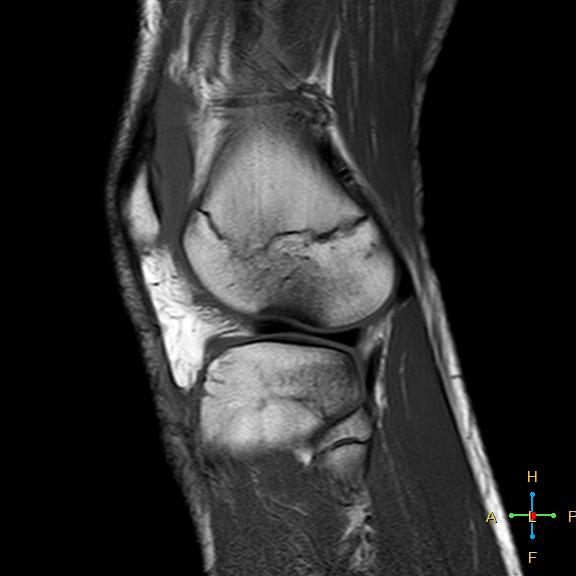 File:Anterior cruciate ligament tear - complete (Radiopaedia 24907-25170 Sagittal T1 3).jpg