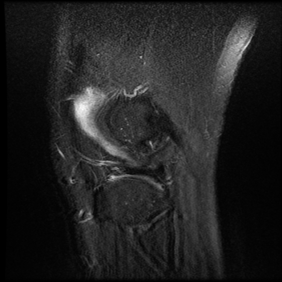 File:Anterior cruciate ligament tear with posteromedial corner injury, bucket-handle meniscal tear and chondral delamination (Radiopaedia 75501-86744 Sagittal PD fat sat 24).jpg