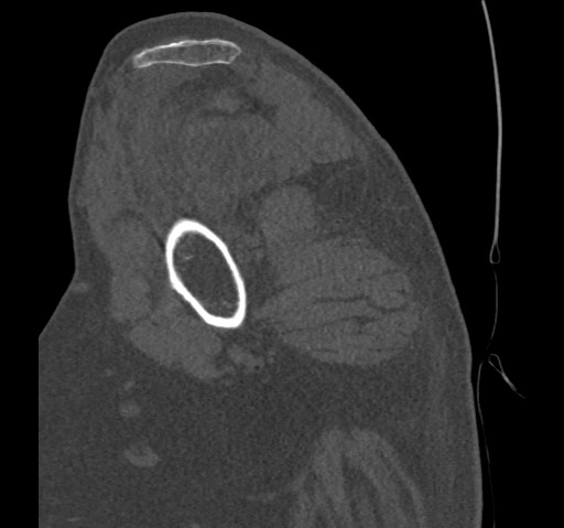 Anterior glenohumeral dislocation with Hill-Sachs lesion (Radiopaedia 62877-71249 Sagittal bone window 22).jpg