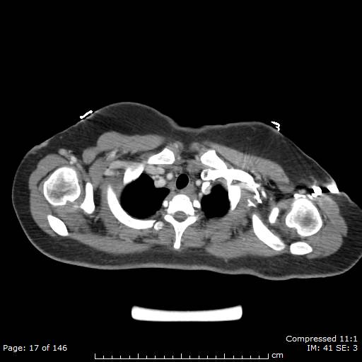Anterior mediastinal B cell Lymphoma (Radiopaedia 50677-56114 A 9).jpg