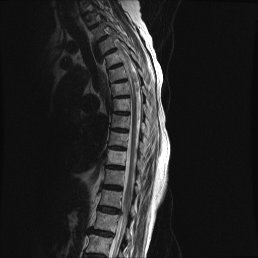 File:Anterior spinal artery syndrome (Radiopaedia 46335-50750 C 4).png