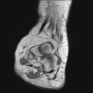 File:Anterior talofibular ligament injury - rupture with soft-tissue impingement (Radiopaedia 38765-40928 Coronal PD 24).jpg