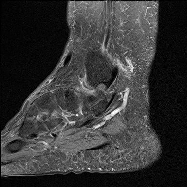 File:Anterior talofibular ligament injury - rupture with soft-tissue impingement (Radiopaedia 38765-40928 Sagittal PD fat sat 4).jpg