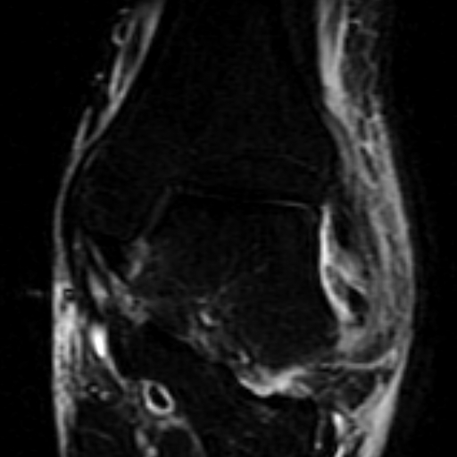 File:Anterior talofibular ligament rupture (Radiopaedia 15831-15484 Coronal STIR 10).jpg