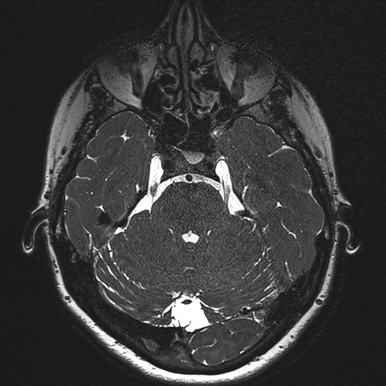 Anterior temporal encephalocele (Radiopaedia 82624-96808 Axial T2 high res 42).jpg