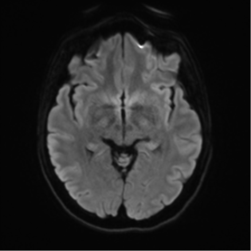 Anterior temporal lobe perivascular space (Radiopaedia 40946-43650 Axial DWI 39).png