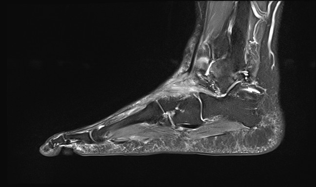 File:Anterior tibial artery false aneurysm (Radiopaedia 88984-105808 Sagittal STIR 10).jpg
