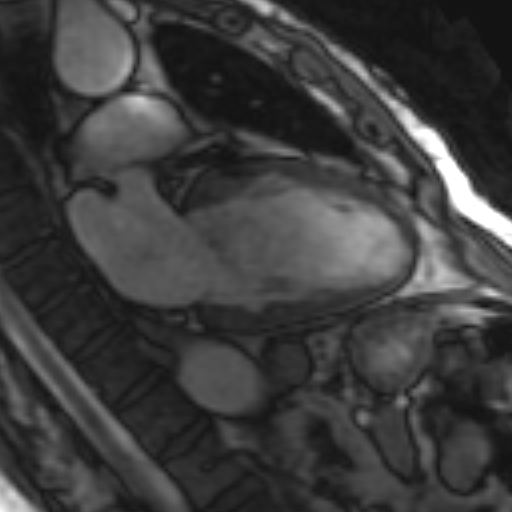 File:Anteroseptal hypokinesia after myocardial infarction (Radiopaedia 15978-15633 2 chamber view SSFE 18).jpg