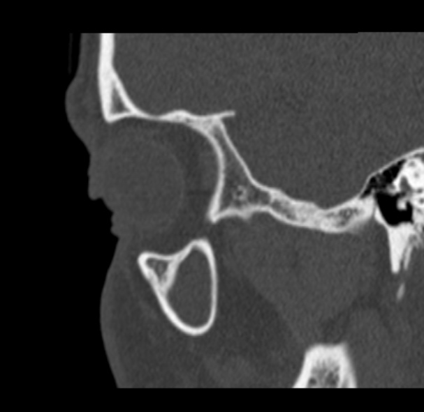 Antrochoanal polyp (Radiopaedia 33984-35202 Sagittal bone window 8).jpg