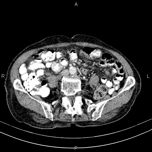 File:Aortic aneurysm and Lemmel syndrome (Radiopaedia 86499-102554 A 52).jpg