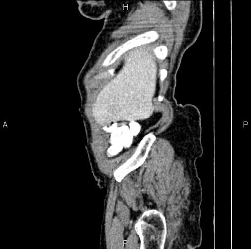 File:Aortic aneurysm and Lemmel syndrome (Radiopaedia 86499-102554 D 5).jpg