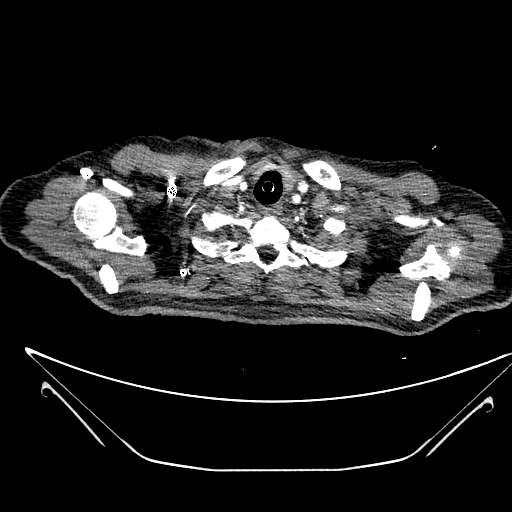 Aortic arch aneurysm (Radiopaedia 84109-99365 B 56).jpg