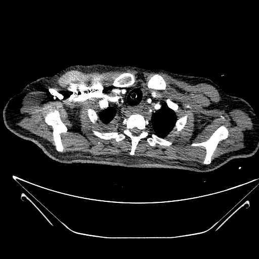 Aortic arch aneurysm (Radiopaedia 84109-99365 B 79).jpg