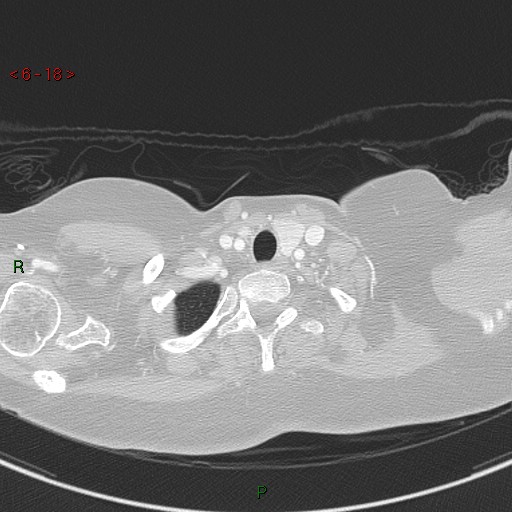 Aortic arch origin of left vertebral artery (Radiopaedia 51520-57286 Axial lung window 18).jpg