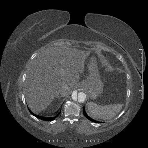 File:Aortic dissection- Stanford A (Radiopaedia 35729-37268 B 23).jpg