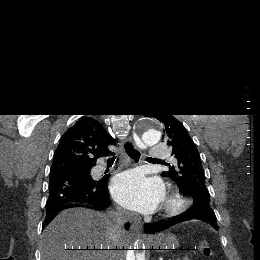 File:Aortic dissection- Stanford A (Radiopaedia 35729-37268 E 20).jpg