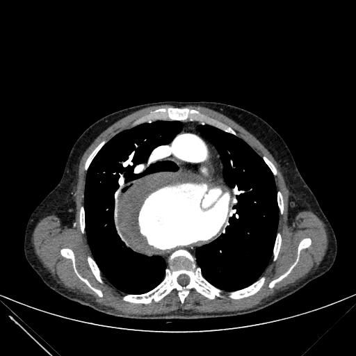 Aortic dissection (Radiopaedia 27466-27665 C+ arterial phase 82).jpg