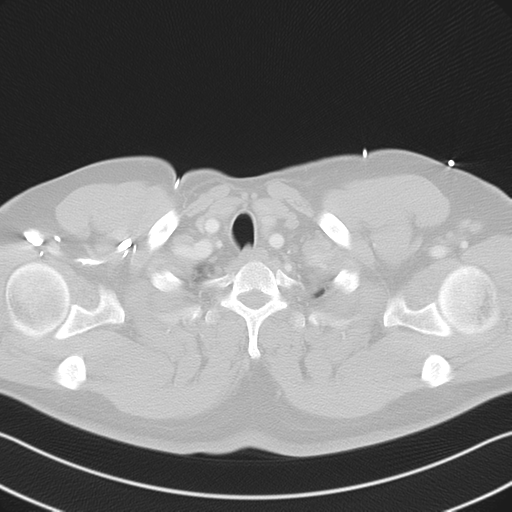 File:Aortic dissection (Radiopaedia 50763-56234 Axial lung window 10).png