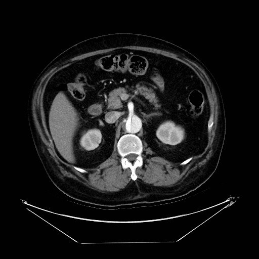 Aortic dissection (Radiopaedia 62562-71000 A 58).jpg