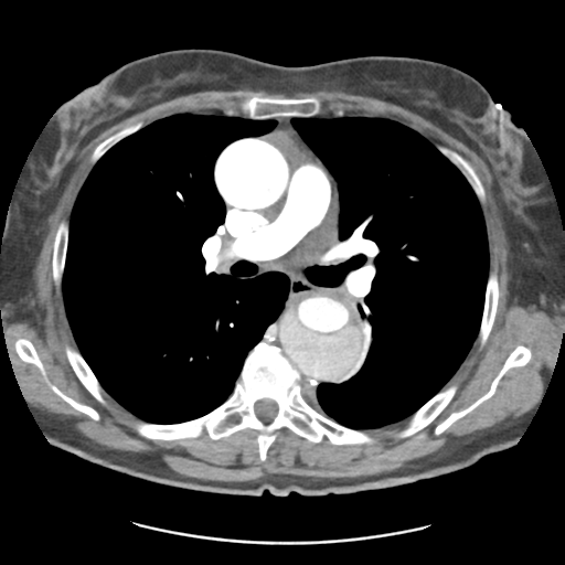 Aortic dissection - Stanford type B (Radiopaedia 50171-55512 A 22).png