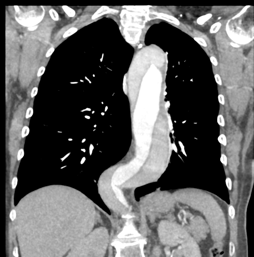 Aortic dissection - Stanford type B (Radiopaedia 50171-55512 B 54).png
