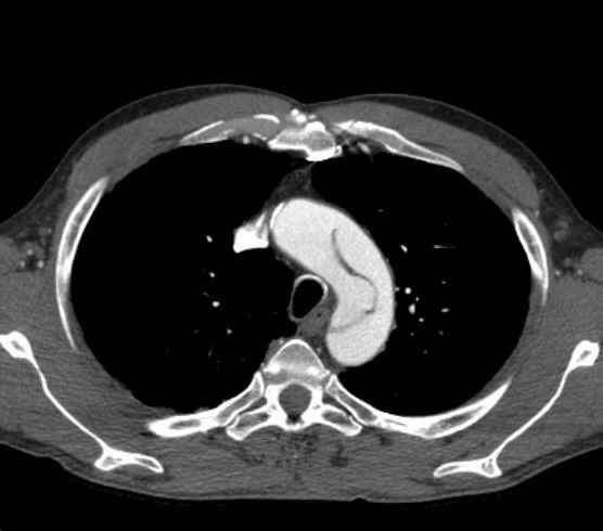 File:Aortic dissection - Stanford type B (Radiopaedia 73648-84437 A 19).jpg