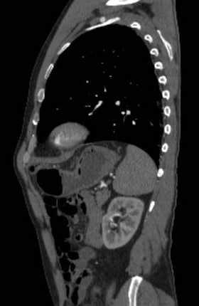 File:Aortic dissection - Stanford type B (Radiopaedia 73648-84437 C 38).jpg
