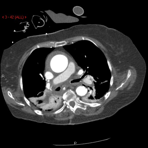 File:Aortic intramural hematoma (Radiopaedia 27746-28001 A 42).jpg