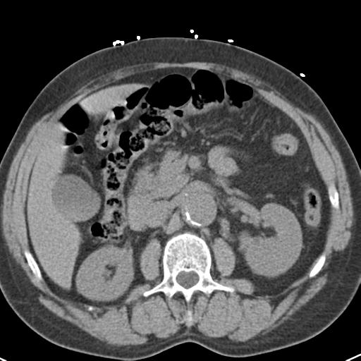 Aortic intramural hematoma (Radiopaedia 31139-31838 Axial non-contrast 60).jpg