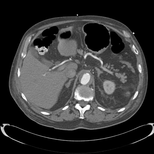 Aortic intramural hematoma (Radiopaedia 34260-35540 B 44).png