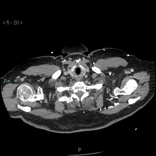 Aortic intramural hematoma (Radiopaedia 48463-53380 C 10).jpg