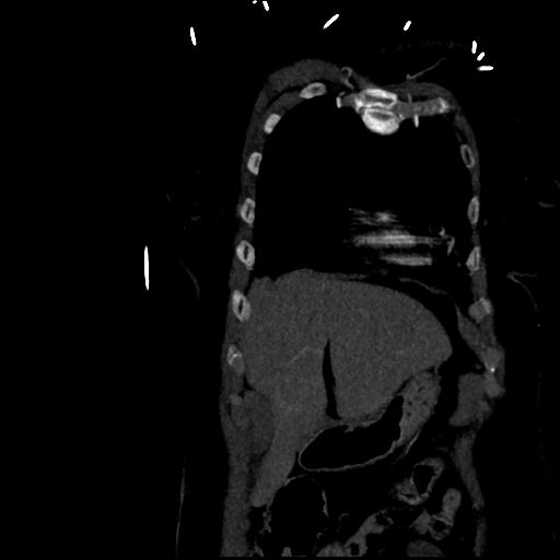 File:Aortic intramural hematoma from penetrating atherosclerotic ulcer (Radiopaedia 31137-31836 C 10).jpg