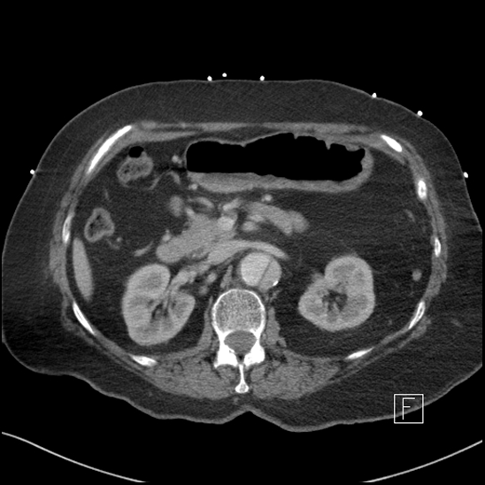 Aortic intramural hematoma with dissection and intramural blood pool (Radiopaedia 77373-89491 E 22).jpg