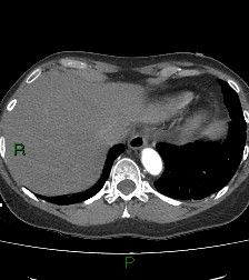 Aortic valve endocarditis (Radiopaedia 87209-103485 C 81).jpg