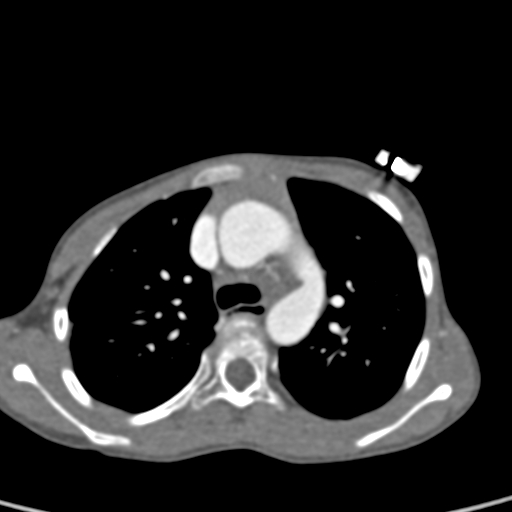 File:Aortopulmonary window, interrupted aortic arch and large PDA giving the descending aorta (Radiopaedia 35573-37074 B 28).jpg