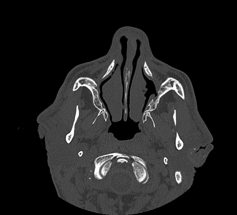 Aplastic maxillary sinuses (Radiopaedia 60030-67561 Axial non-contrast 21).jpg