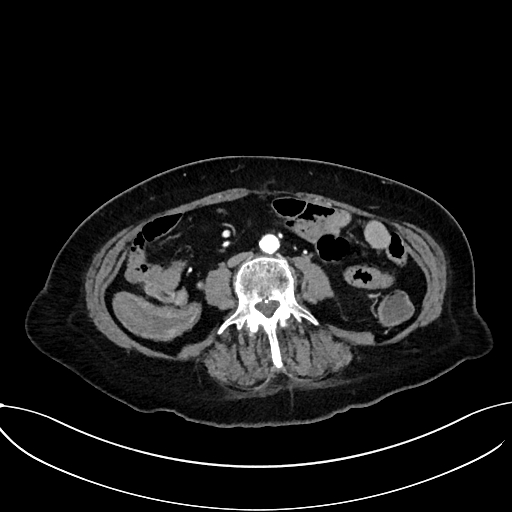 File:Appendiceal hemorrhage (Radiopaedia 70830-81025 A 71).jpg