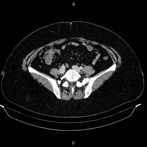 Appendiceal mucocele (Radiopaedia 83280-97688 Axial With contrast 74).jpg